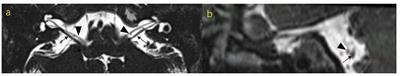 Microstructural changes of the vestibulocochlear nerve in patients with Ménière's disease using diffusion tensor imaging